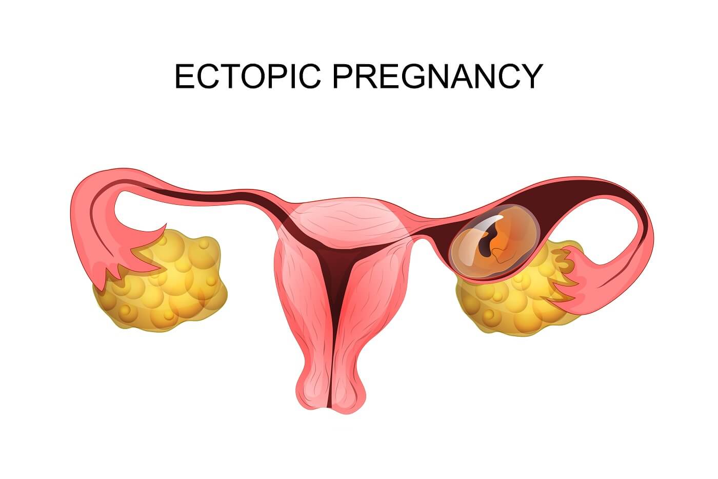 Ectopic Pregnancy: Causes, Symptoms & Treatments