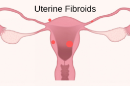 fibroids