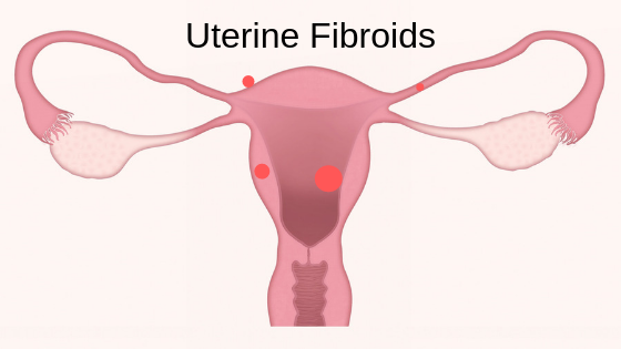 A 43-year-old woman gets pregnant after fibroid removal surgery at