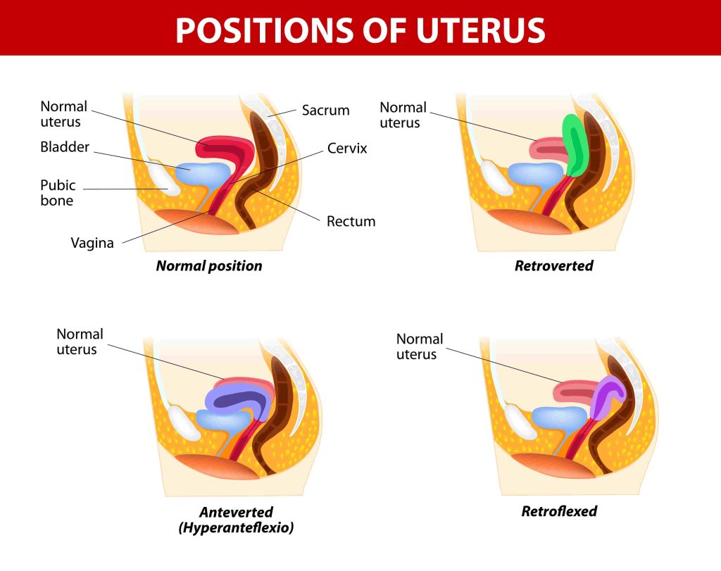 Retroverted uterus: definition, causes, symptoms
