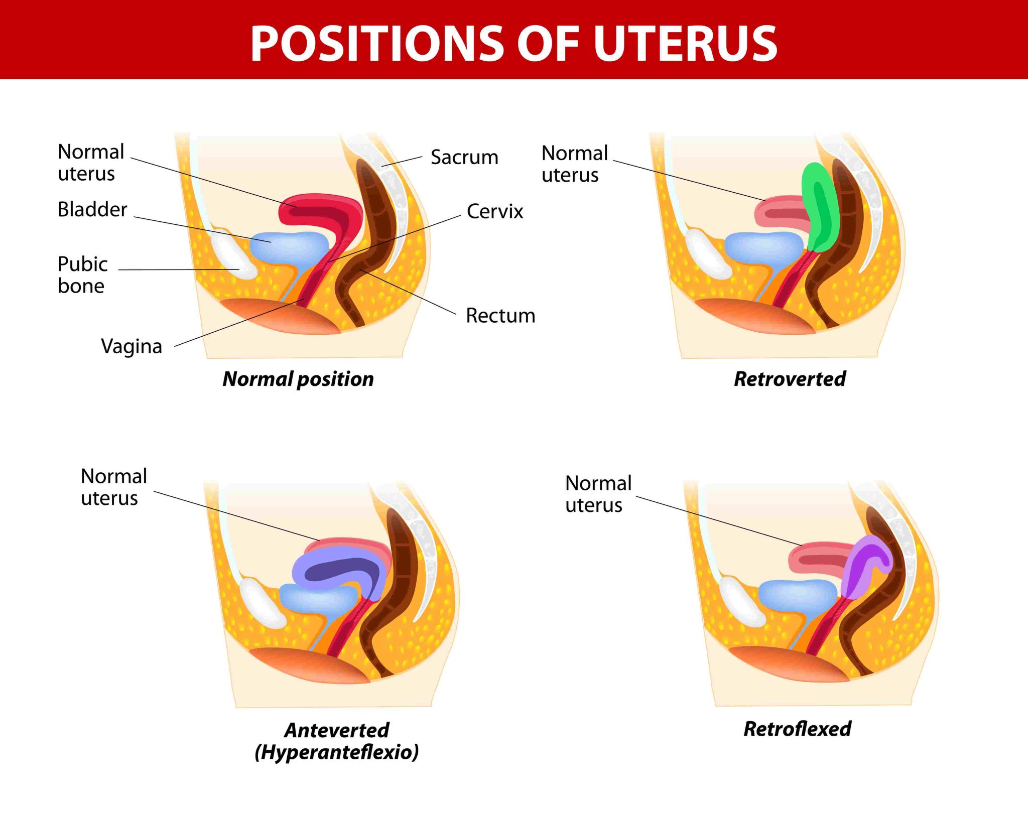 Retroverted uterus: definition, causes, symptoms