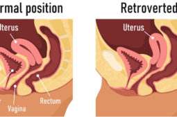 retroverted uterus pregnant