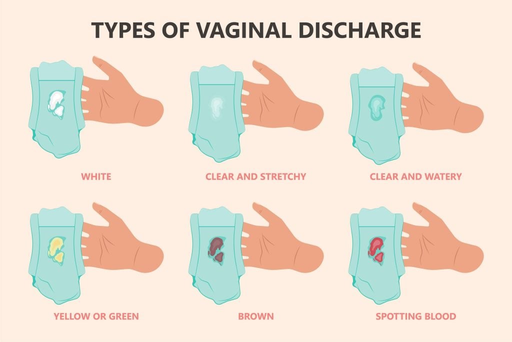 vaginal discharge