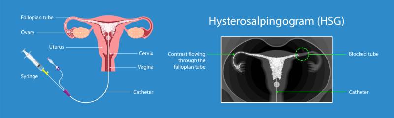 Hysterosalpingography